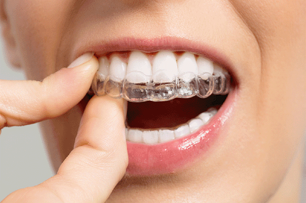 選對箍牙醫生很重要!有冇深圳牙齒矯正醫生推介?
