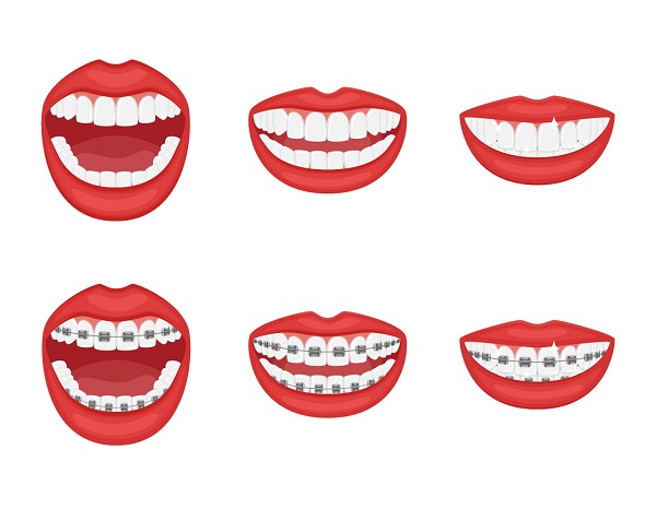 如何預防牙齒錯頜畸形?深圳箍牙邊間好?