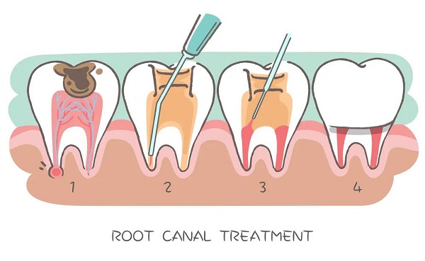 根管治療的步驟