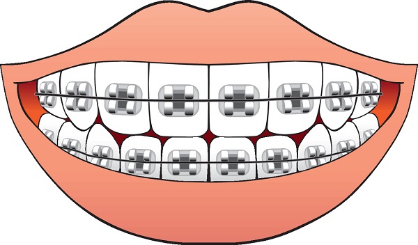 深圳牙齒矯正多少錢