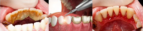 深圳洗牙多少錢