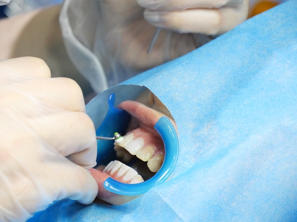 洗牙要拋光噴砂嗎