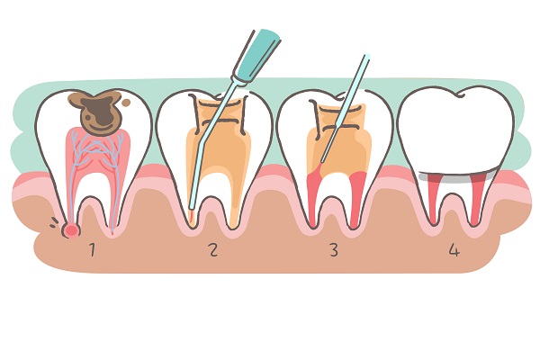牙神經暴露怎么辦