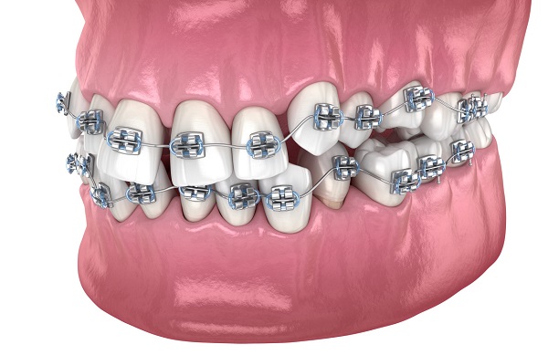 成人牙齒縫隙大可以矯正嗎