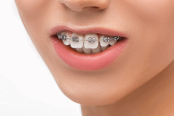 成人嘴凸還能矯正嗎