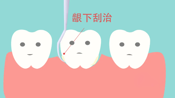 深圳牙周治療需多少錢